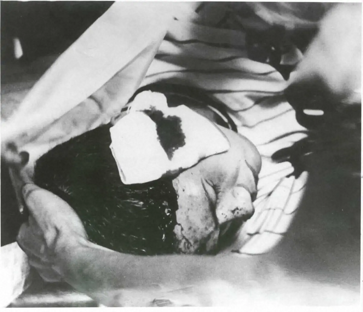 1970年8月26日の阪神―広島戦（甲子園）の3回、広島・外木場から左側頭部に死球をうけ、こん倒した田淵。出血した田淵は左耳鼓膜を裂傷する重傷