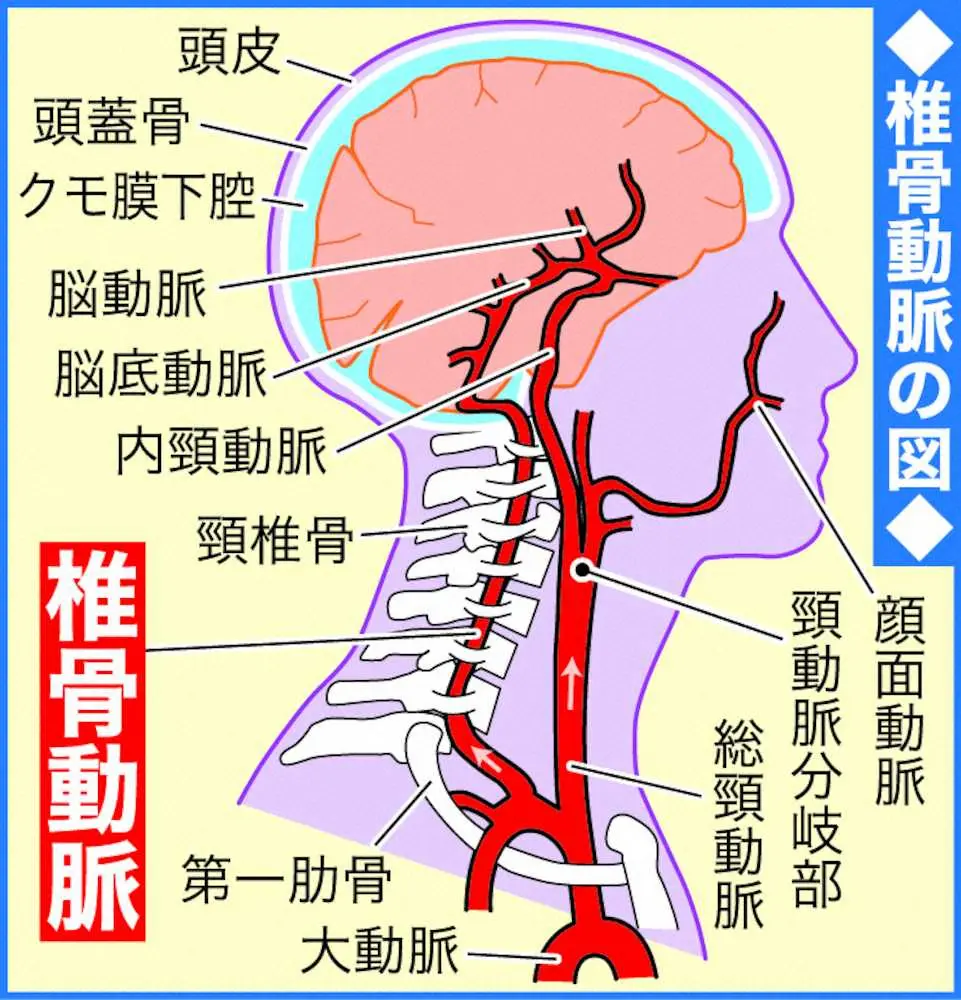 千鳥・ノブ入院の椎骨動脈解離とは　悪化すればくも膜下出血も、鎮痛剤効かない頭痛は受診を