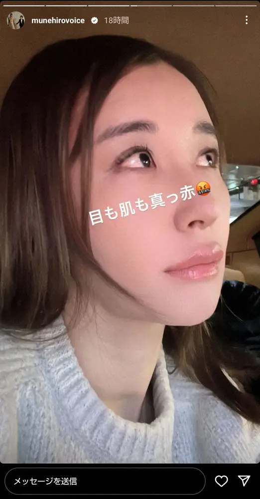 鈴木紗理奈「目も肌も真っ赤」　重度の花粉症で新たな治療へ「鼻の中にボトックスを…効くかなぁー」
