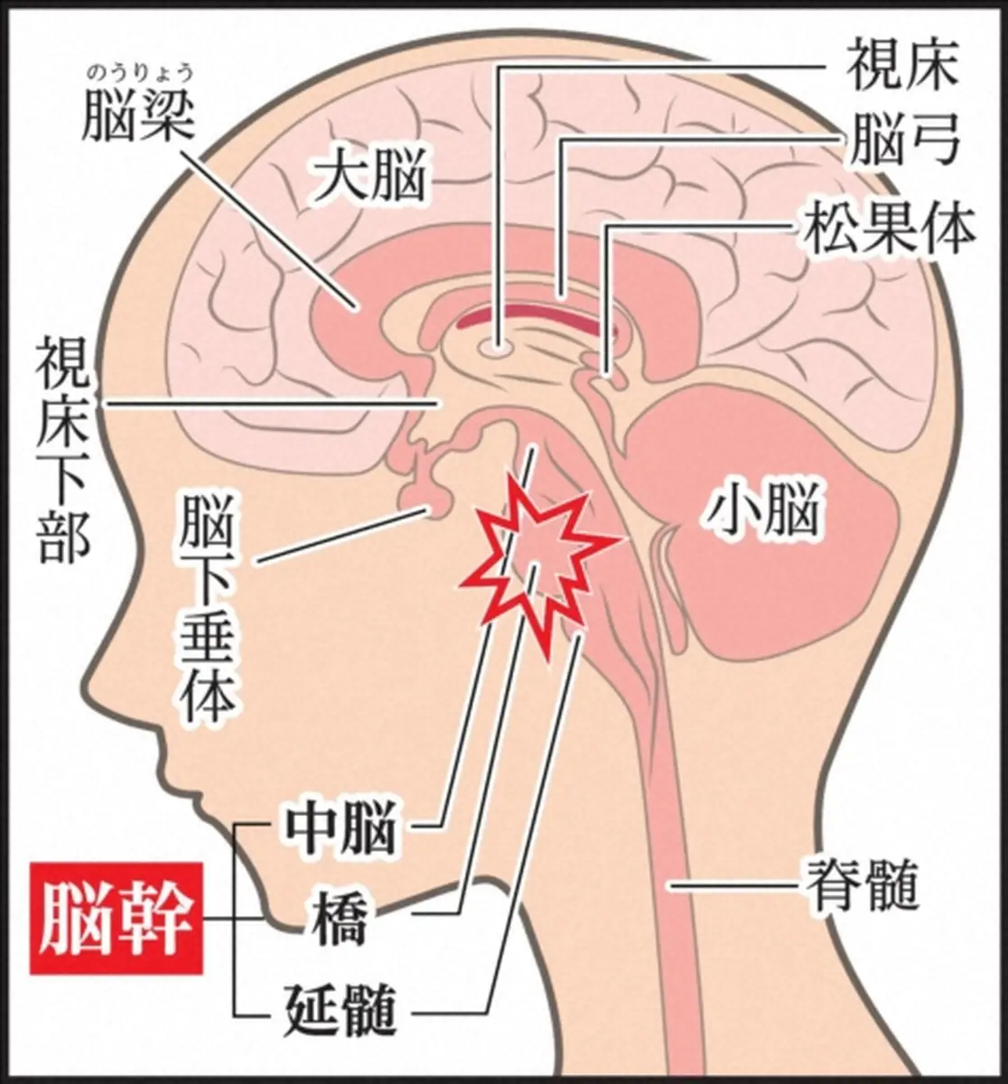 脳幹出血とは…脳中央下部の奥深くに位置　手術難しく